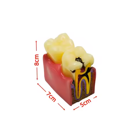 Dental 6 Times Caries Comparsion Tooth Models Study Models For Dentist Studying Teaching Anatomy Pra