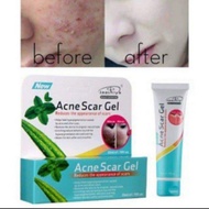 Aloe Vera Acne Scar Gel, Acne Scar Treatment, Acne Pimple Spot Scar Removal Gel