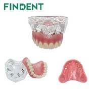 Upper Dental Model Teeth Implant Restoration Bridge Removable 4 Implant Teeth Model Transparent For 