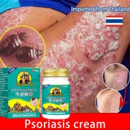 Itchy fungus cream Removes eczema, psoriasis, dermatitis, hives, scabies, tinea versicolor herbal ex