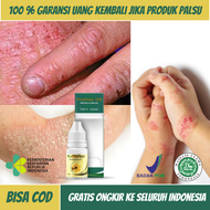 Obat Gatal Kulit Eksim, Obat Eksim Kering, Obat Eksim Menahun, Obat Eksim Basah, Obat Gatal Gatal Se