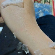 Peeling TCA Gel 40% - Peeling Badan - Pemutih Tubuh - Pengelupasan