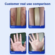 Japan anti itch antifungal cream anti viral relief itchy redness peeling relief eczema skin sulfur a