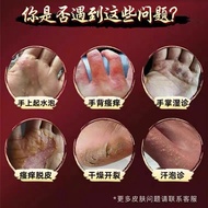 Foot Peeling Foot Odor Itching Cream Sterilization Bad Foot Small Blister Type Remove Roots Toe Blis
