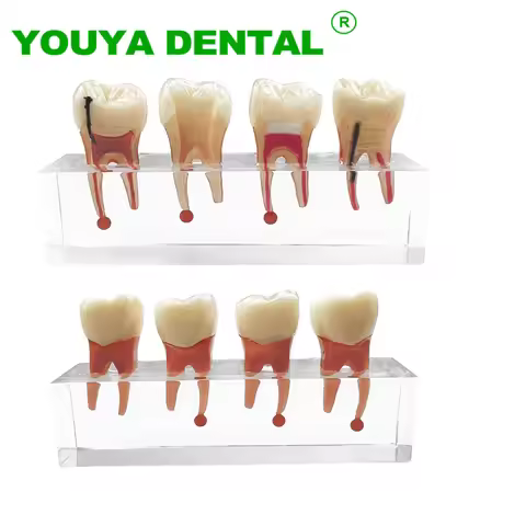 Dental Teeth Model Endodontic Caries Treatment Clear Demonstration Model For Study Teaching Training