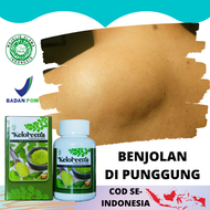 Obat Benjolan Di Atas Pundak Mengecilkan Kelenjar Lemak Di Belakang Pundak Kanan Kiri Lipoma Besar T
