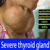 Natural Herbal Thyroid Oitment | Thyroid Nodule Care Neck Coarse Massage Neck | Thyroid Remover Oint