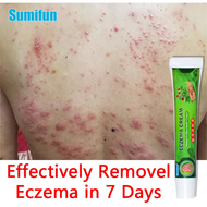 Sumifun Eczema Cream Gamot Sa Kati Kati Sa Balat Ointment for Itchy Skin and Allergy