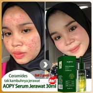 The most effective Acne and Acne scar Serum Acne Treatment Serum 30ml Removes Acne and Acne Scars Fa