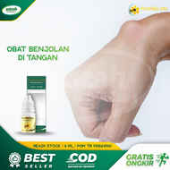 Obat Benjolan Di Tangan - Obat Benjolan Siku Tangan - Obat Benjolan Di Jari Tangan - Obat Untuk Benj