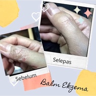 Balm Ekzema (homemade)
