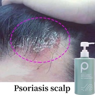 Syampoo kelemumur dan gatal kepala Psoriasis scalp Itchy scalp Anti dandruff shampoo Lifusha Shampoo Oil Control
