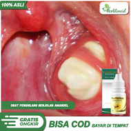 Obat Herbal Penghancur Amandel Tanpa Operasi/Radang Amandel Menahun/Propolis SM
