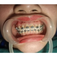 Ricketts slot 0.18 braces, Bio advanced orthodontic braces.