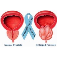 Prostate Health Issues Supplement for men health saw Palmetto