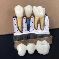 Transparent hard plastic implant consulting jaw model/ Implant implant implant consulting jaw model 