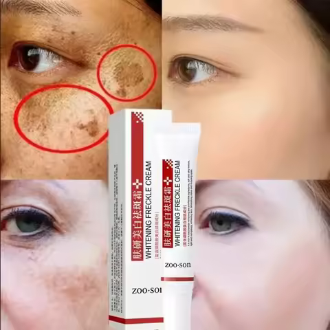 Freckle Removing Cream Women Face Quick Dark Spots Pigmentation Remove Whitening Cream Fade Melasma 