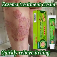 Eczema Cream/Psoriasis krim/Tinea 湿疹膏湿毒清软膏(Herbal Antibacterial Cream) Ubat Kurap/panau