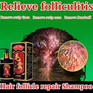 Anti Dandruff Shampoo Psoriasis shampoo Scalp shampoo 300ml scalp treatment itchy scalp shampoo 毛囊修复