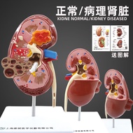 Human Kidney Anatomy Model Disease Change Kidney Model Kidney Model Internal Organ Anatomy Model Tea