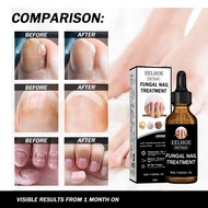 EELHOE Nail Repair Essence Solution Gray Nails Repair Removes Onychomycosis Serum Fungal Nail Treatm