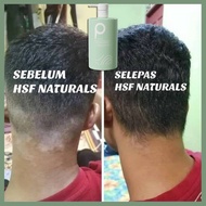 Syampoo kelemumur gatal kepala Psoriasis scalp Itchy scalp Antifungal shampoo scalp psoriasis Reliev