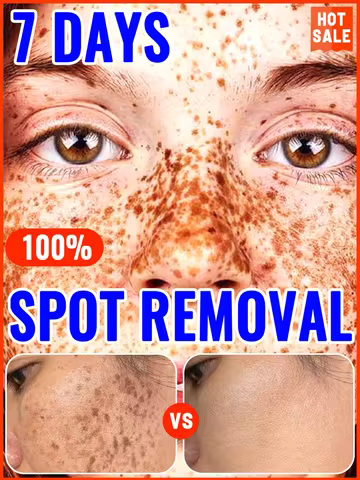 freckle cream，remove freckles，Melasma，dark spots，Hyperpigmentation, Age Spots, Sun Spots, Whitening 