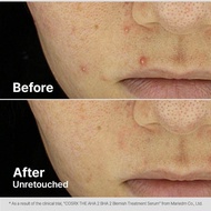 COSRX The AHA 2 BHA 2 Serum Trị Mụn 50ml