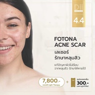 [E-Voucher] Dii Aesthetic : Fotona Acne Scar (เลเซอร์รักษาหลุมสิว)