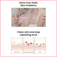 ◇ ◺ ◊☜ Safeguard DETOX Acne Soap Dual Use Wash 99.9% Bacteria New Old Packaging Random Chamomile Wh