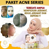 ACNE FACIAL SKINCARE ACNE SCAR REMOVAL MEDICINE ACNE SERIES ACNE CREAM SCAR Blackhead CREAM