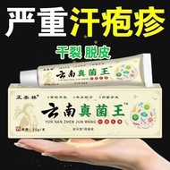2026新款汗疱疹手上水泡手痒脱皮干裂水泡真菌感染皮肤瘙痒湿疹藓止痒乳膏Dyshidrotic eczema: blisters on the hands, itching, peeling, cra