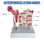 [Fast Shipping COD] Human femur osteoporosis anatomy model, leg bone anatomy section, spinal column 
