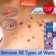 Flat Eliminate Wart Pen Liquid Hand Foot Warts Remove Filiform Flat Warts Condyloma Acuminatum Wart 