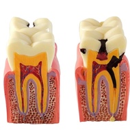 Dental Model Anatomy & Carees - Dental Practice Tool