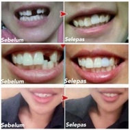 ready stock!! Diy Gigi Palsu 15 gram temporary teeth