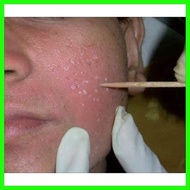 ♨ ▬ ☂ TCA Peel/Cross Solution 100% 15ml