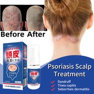 30mlSeborrheic Dermatitis Spray Scalp Treatment Scalp Psoriasis Anti Dandruff Ubat Kulit Kepala Berk
