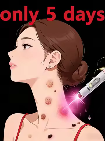 Blue light wart removal tool, more discounts on sets