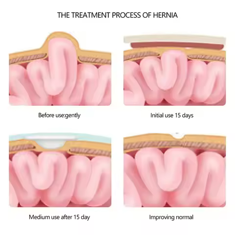 2pcs Umbilical Hernia Therapy Treatment Belt Breathable Bag Elastic Cotton Strap for 0-1 Years Old B