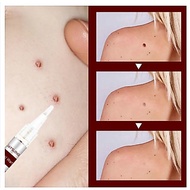 3ml Wart Treatment Pen Skin Tags Moles Remover Warts Corn Remover