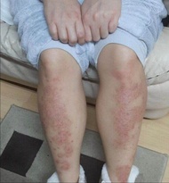 BÔi Vẩy Nến CHÀM Eczema bong chóc đóng vẩy trắng tay chân kem Cải thiện Các Vấn Đề Da Liễu Vẩy nến E