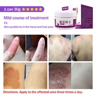 Itchy Hands Itchy Skin Itchy Skin Allergy Mosquito Bites Antiseptic Natural Herbal Zinfandel Antibac