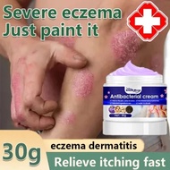 Psoriasis Eksim Salep Gatal / Psoriasis Ointment Psoriasis Eczema Cream Psoriasis Treatment Cream fo