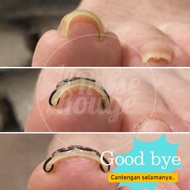 Ingrown Toenail Corrector – anti-grown Toenail & Ingrown Toenail Remover