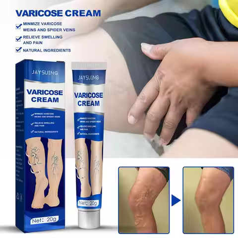 ointment for varicose veins Effective varicose vein relief cream to relieve Leg vasculitis phlebitis
