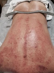筋膜刀療程+手法