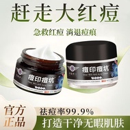 Dr. John Acne Removal Cream Remove Acne Marks Medical Acne Marks Remove Acne Marks Fade Acne Marks A