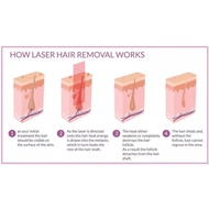 Smart Android Permanent 755nm 808nm 1064nm Professional Ice Painless Diode Laser Hair Removal Machin