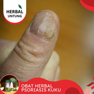 Obat Herbal Psoriasis Kuku Obat Jamur Infeksi Kuku Jamur Kuku Busuk Propolis Sm Halal Bpom